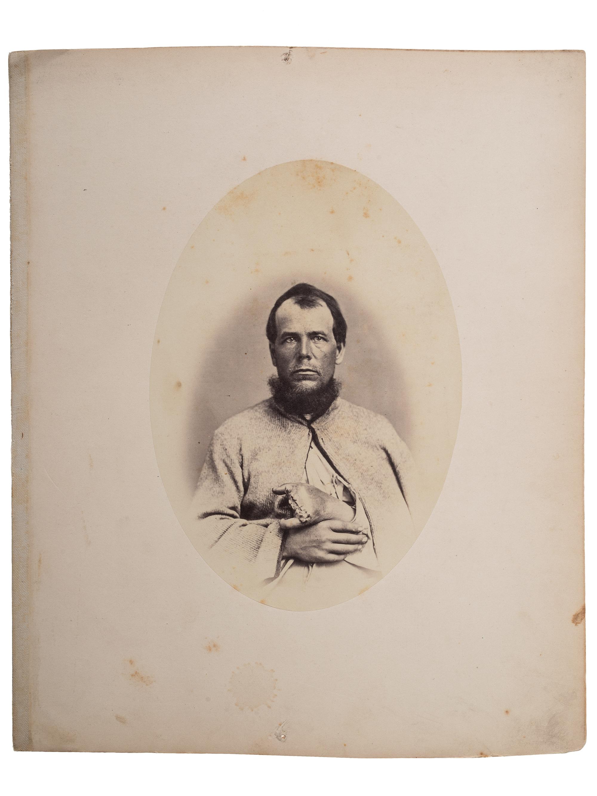 [CIVIL WAR]. Albumen photograph of Private Rufus T. Giffin, Company M, 14th Regiment New York, Heavy Artillery, wounded Fort Steadman, Virginia, 25 March 1865, infection of left hand, photographed and assembled by Reed Brockway Bontecou, M.D.