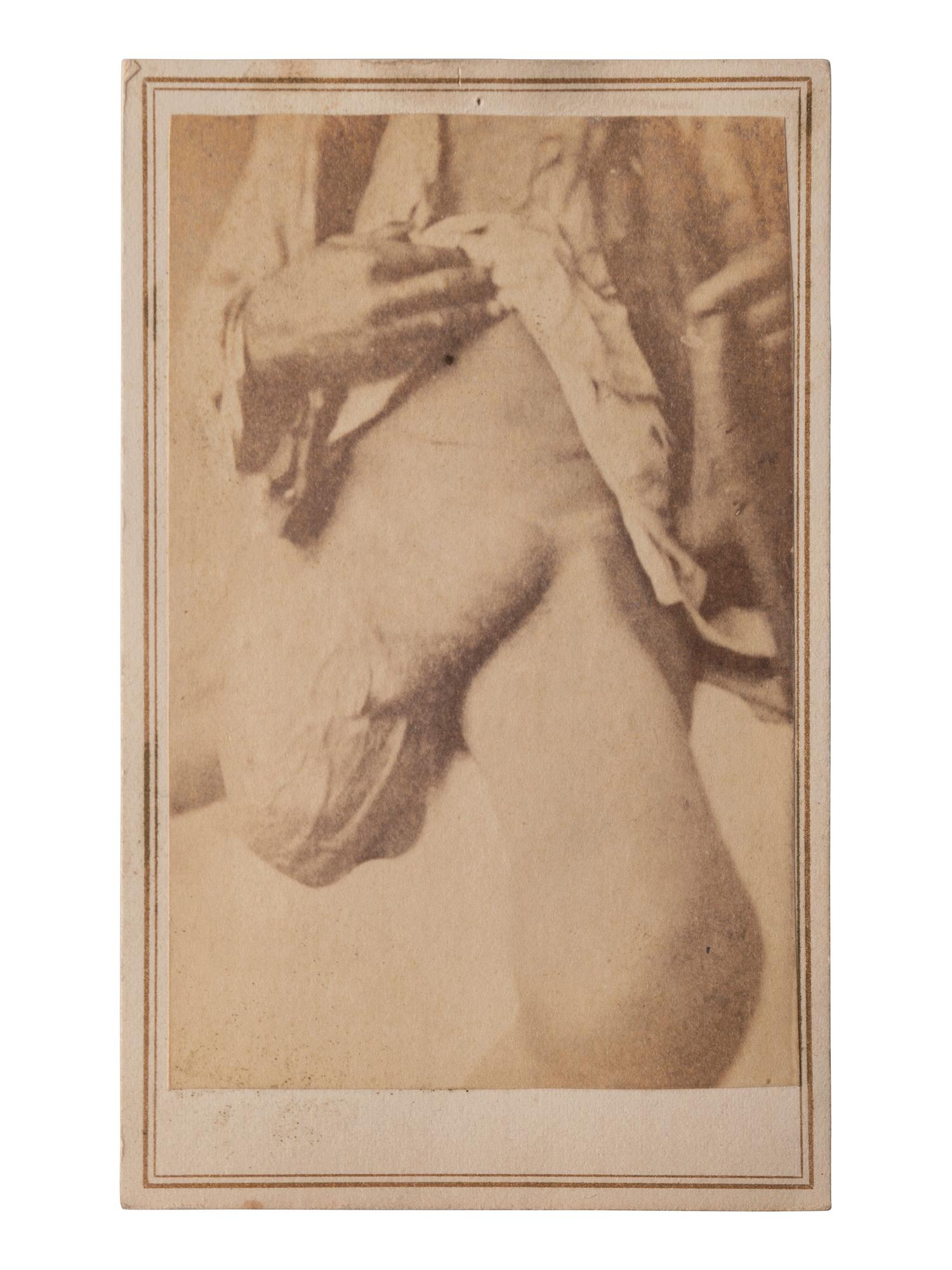[CIVIL WAR]. A group of 5 CDVs of medical specimens issued by the Surgeon General's Office, Army Medical Museum. [Washington, DC], ca 1860s.