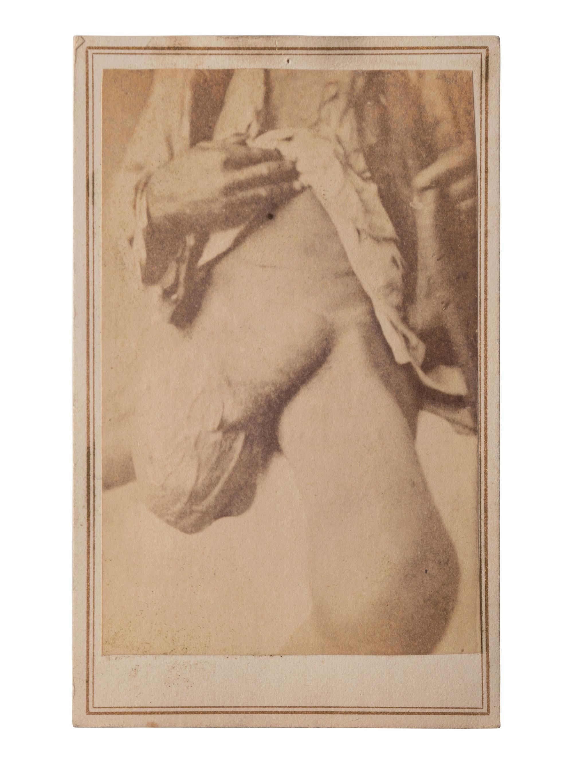 [CIVIL WAR]. A group of 5 CDVs of medical specimens issued by the Surgeon General's Office, Army Medical Museum. [Washington, DC], ca 1860s.