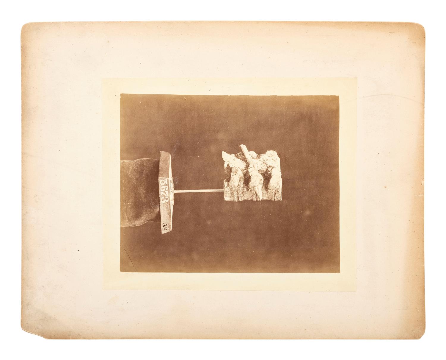 Indian Wars -- Texas Arrow impacted in the Tranverse [sic] Process of the Fourth Dorsal Vertebra . Army Medical Museum, ca 1869.